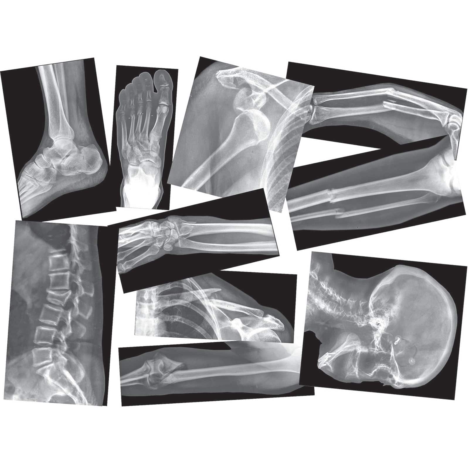 Roylco&#xAE; Broken Bones X-Ray Set, Pack of 15